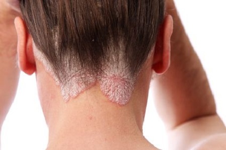 Schuppenpflechte-Psoriasis am Haaransatz und auf der kopfhaut
